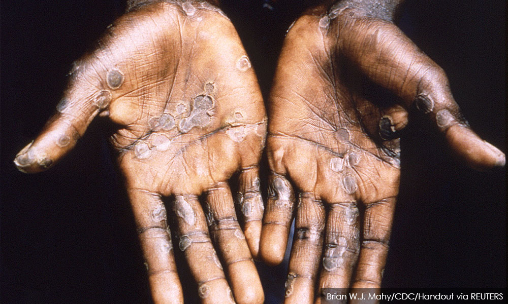 Monkeypox: Get vaccinated before travelling overseas – expert – Malaysiakini