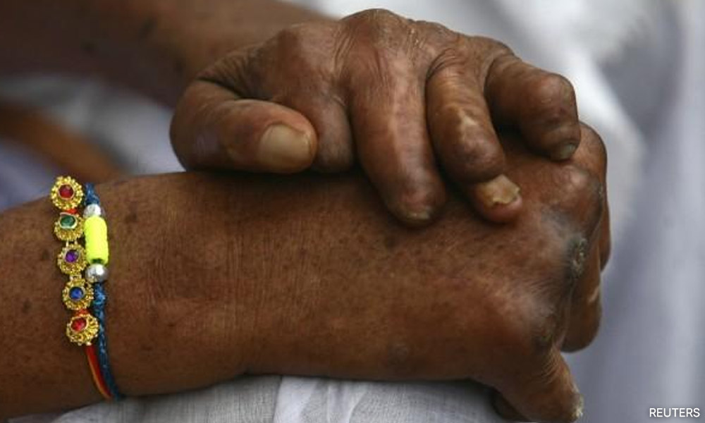 Zaliha: Leprosy cases in M'sia increased 15.5pct in 2022