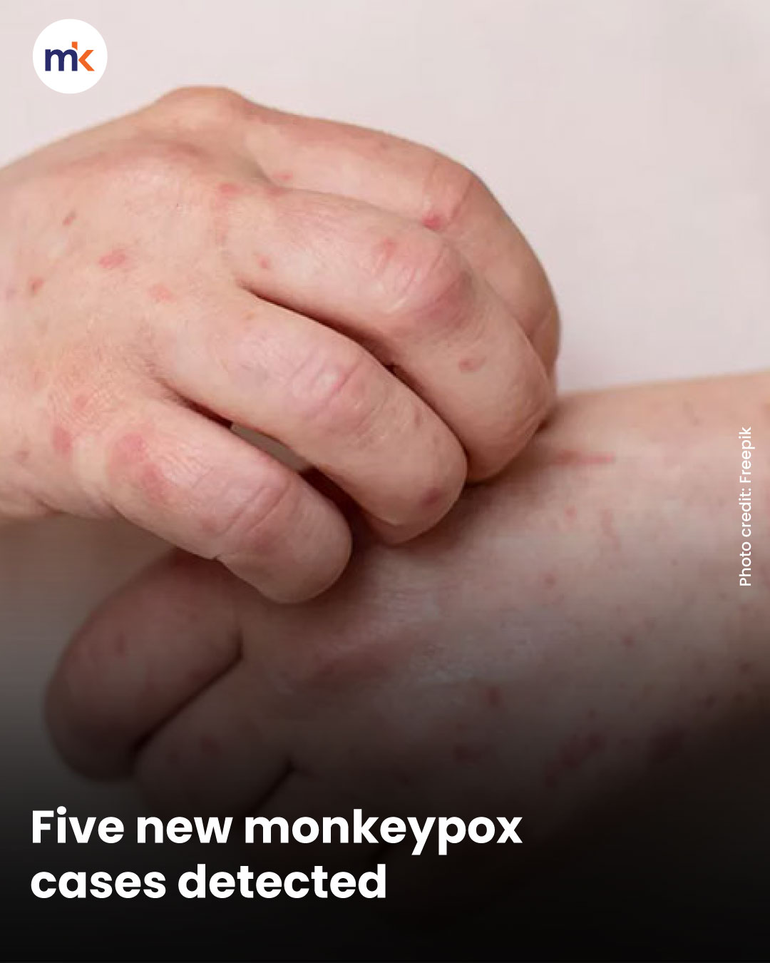 Five new monkeypox cases detected