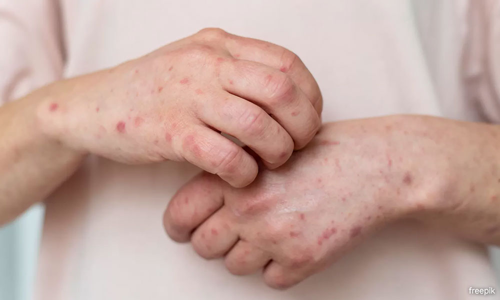 Five new monkeypox cases detected
