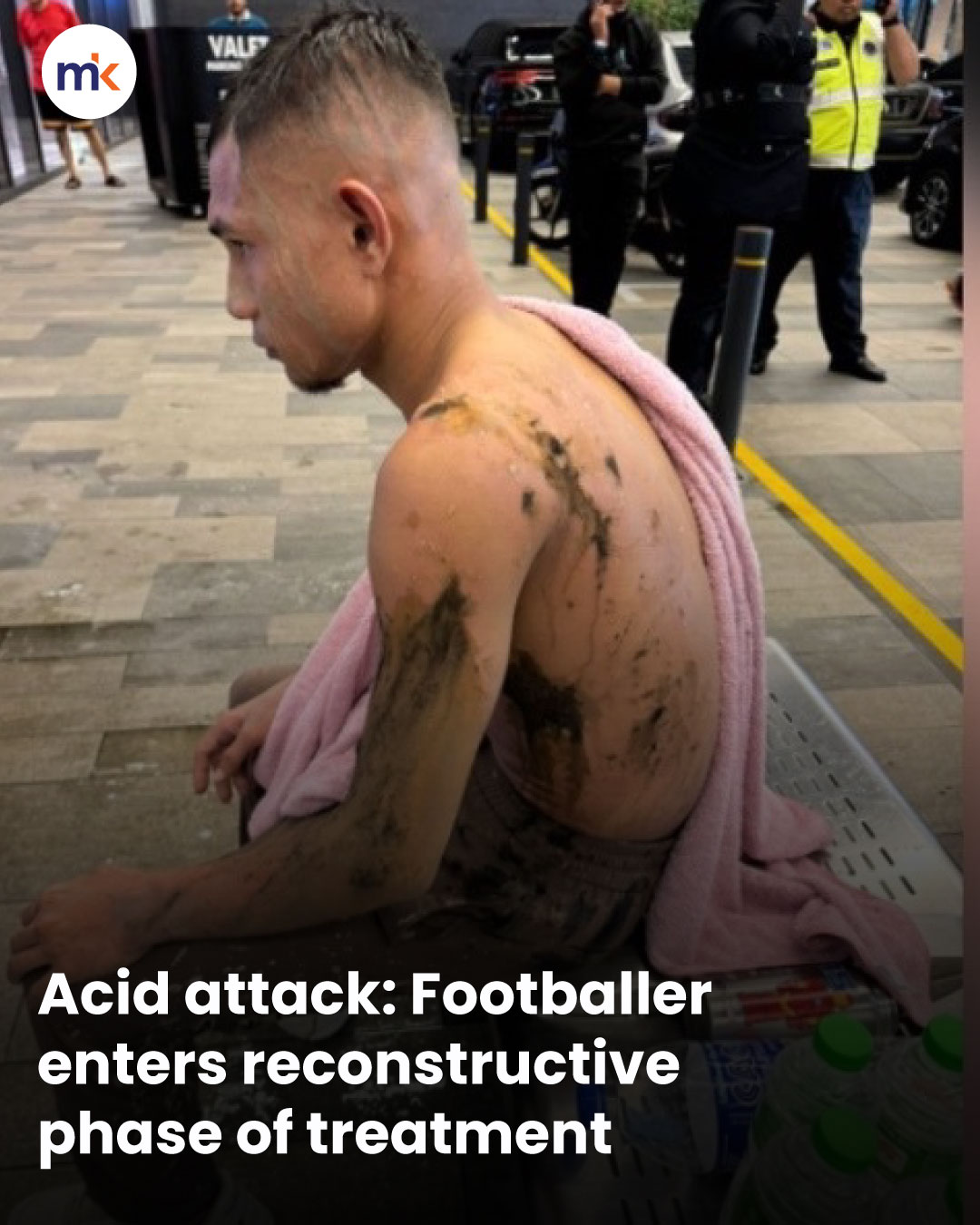 Acid attack: Footballer enters reconstructive phase of treatment