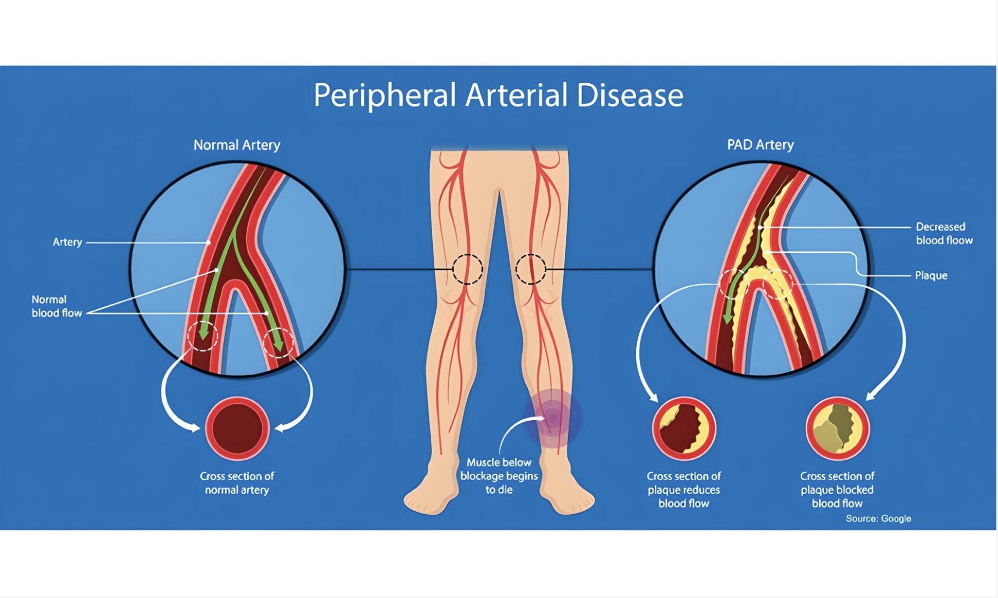 Leg Pain Isn’t Just ‘Old Age’— Diabetes Could Be to Blame