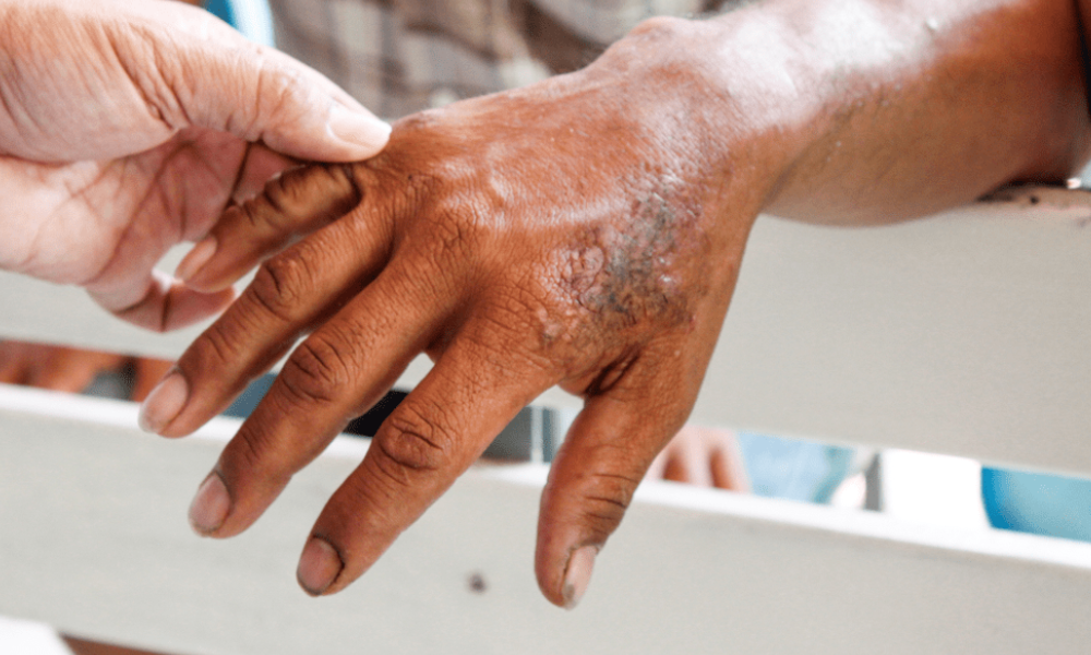 Leprosy: Preventive steps in place in 2 Orang Asli villages since August