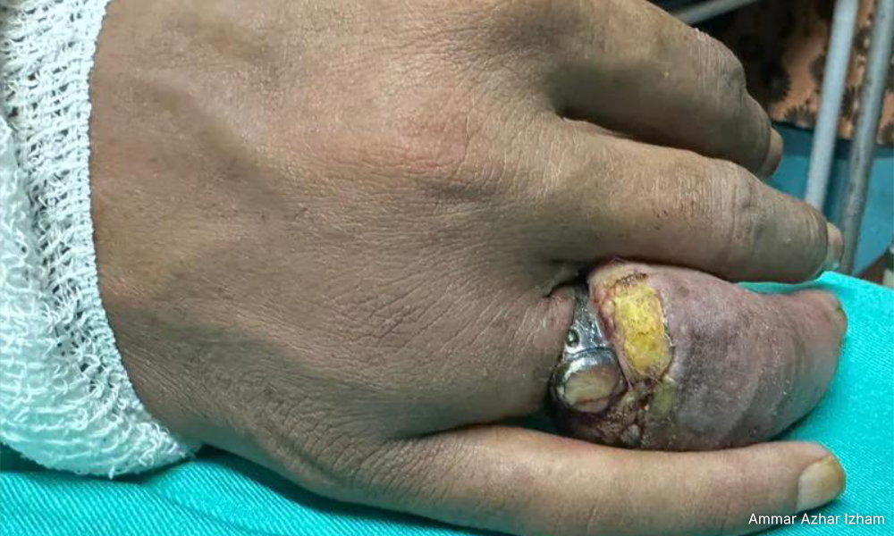 ‘Cincin hikmat’ akhirnya ditanggalkan dengan pisau bedah