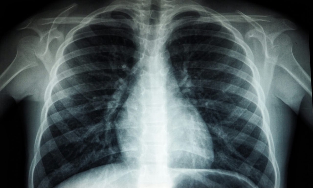 2,571 kes Tibi dilaporkan sehingga minggu epidemiologi ke-5