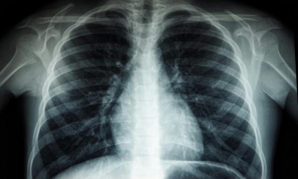 2,571 kes Tibi dilaporkan sehingga minggu epidemiologi ke-5